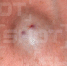 Шишка после укуса насекомого / Фото: Shot - ИА Амител
